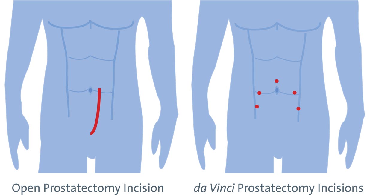 prostate incision comparison