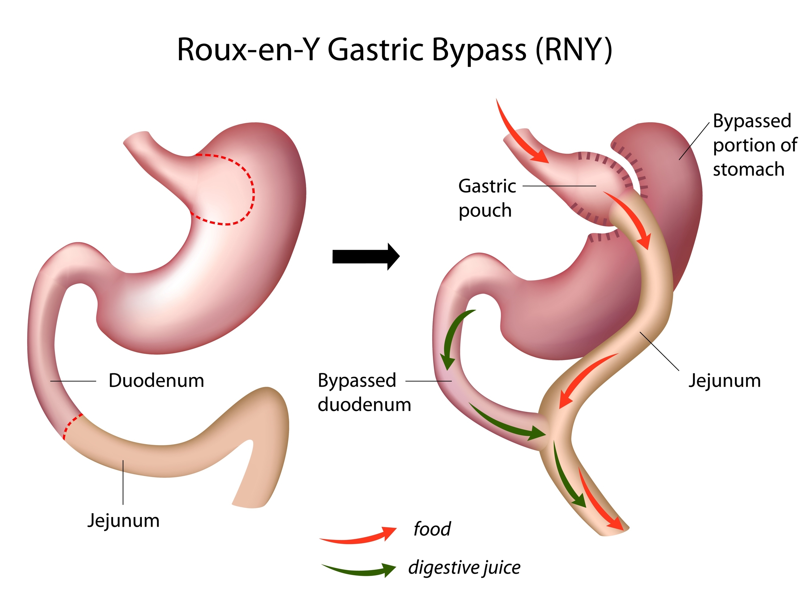 roux-en-y-gastricbypass-web.jpg