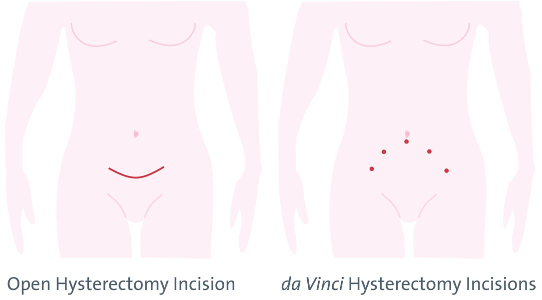 Hysterectomy incision comparison