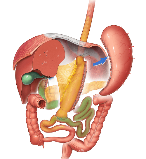 Duodenal Switch