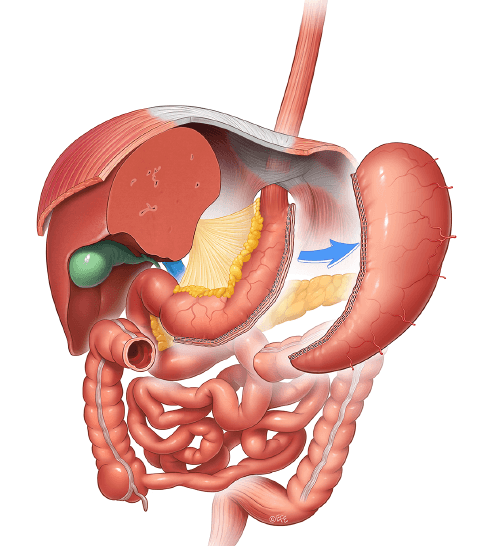 verticalsleevegastrectomy-web.jpg